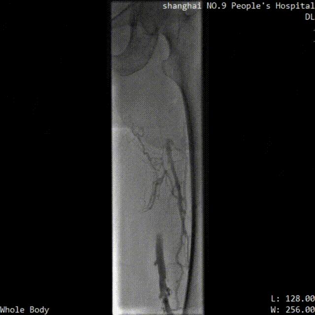 中国医院血栓清除技术,血栓消除的高端技术