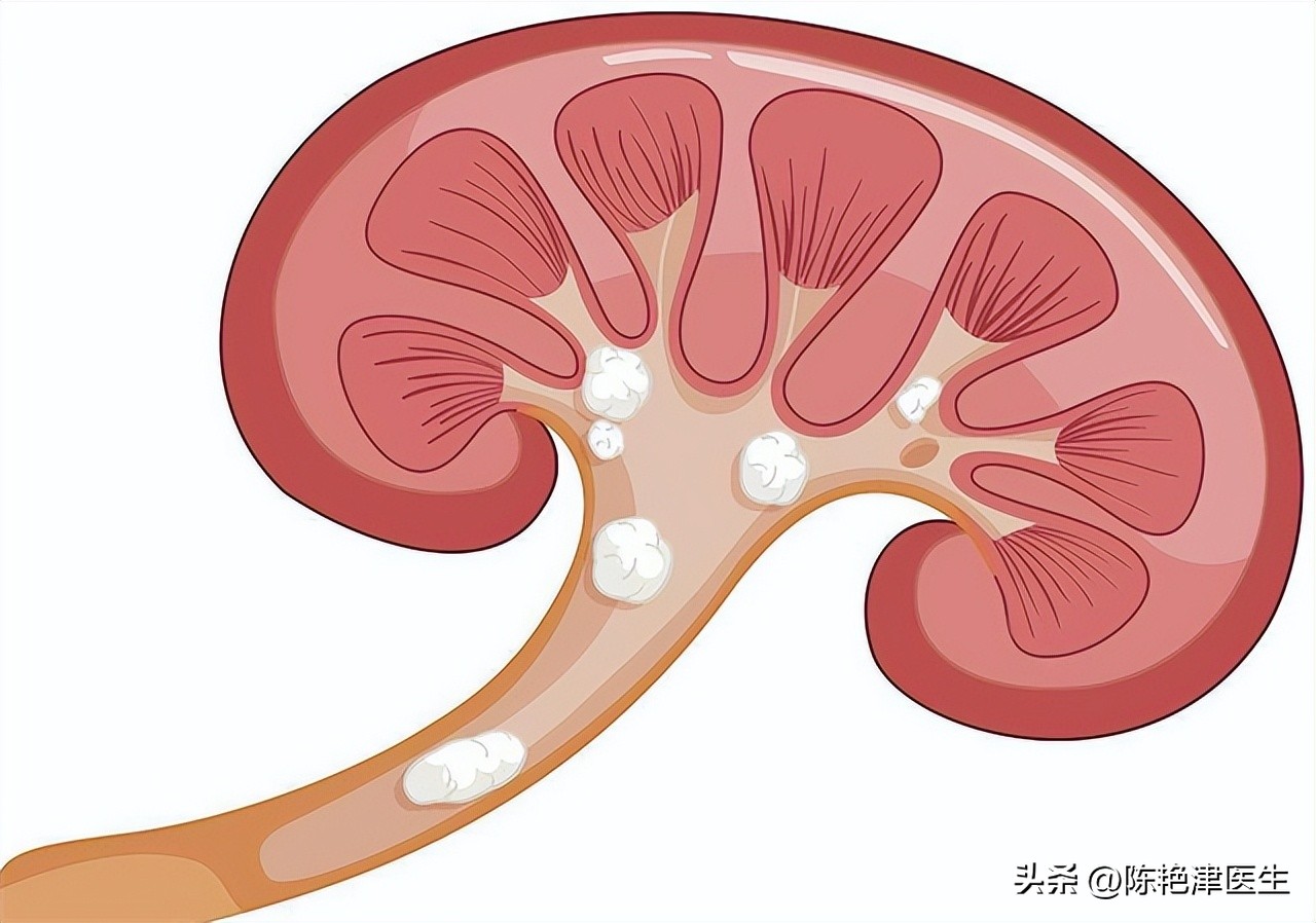 体检查出有肾结石要注意什么,体检有肾结石应该怎么处理