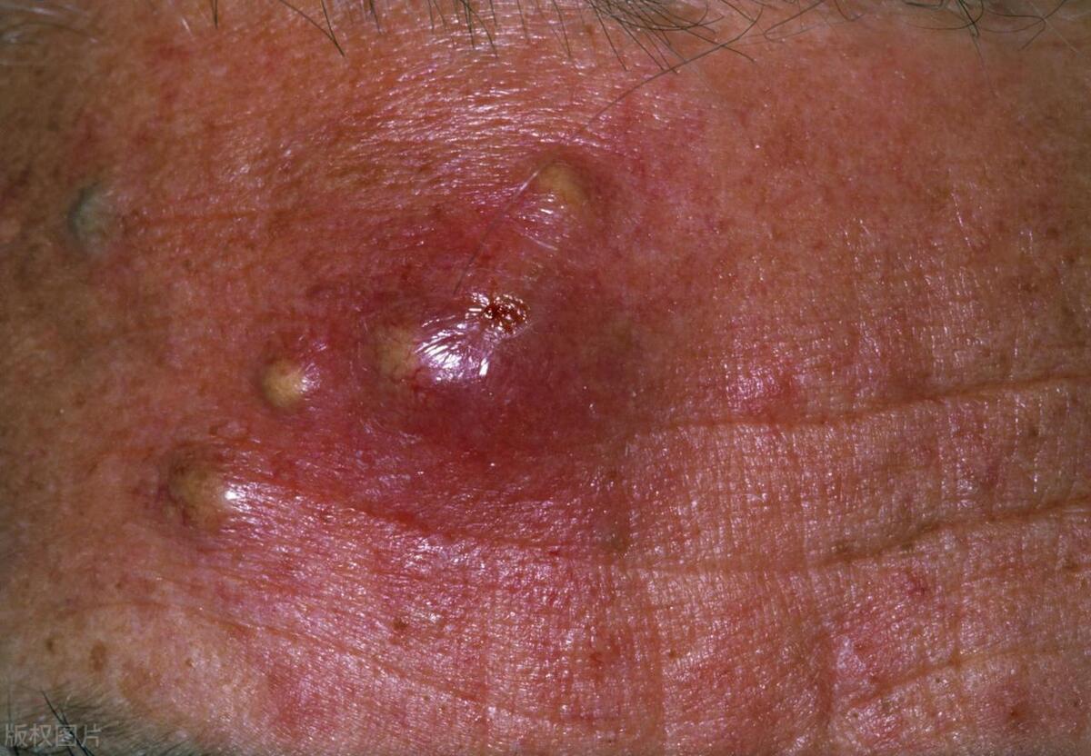 头皮经常长疙瘩什么原因,头皮总长疙瘩怎么回事手摸还疼