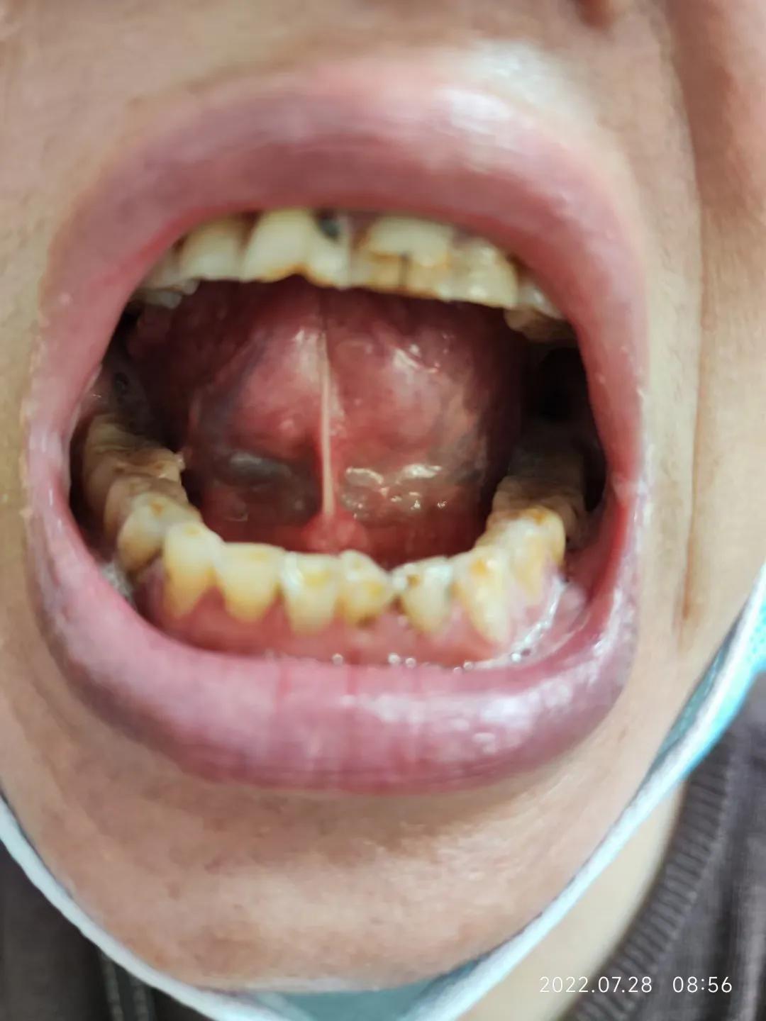 口服中药3个月，确诊5年的干燥综合征患者病情明显缓解