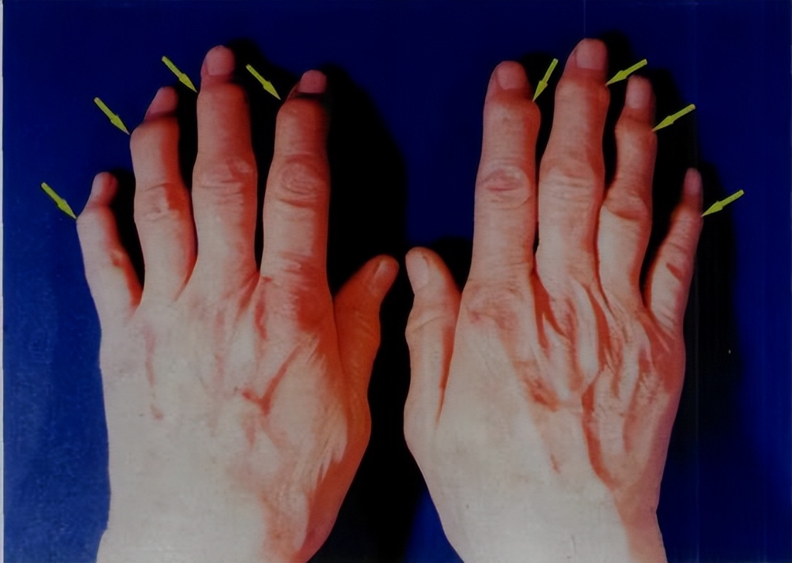 风湿免疫类疾病最怕什么,风湿免疫疾病如何预防