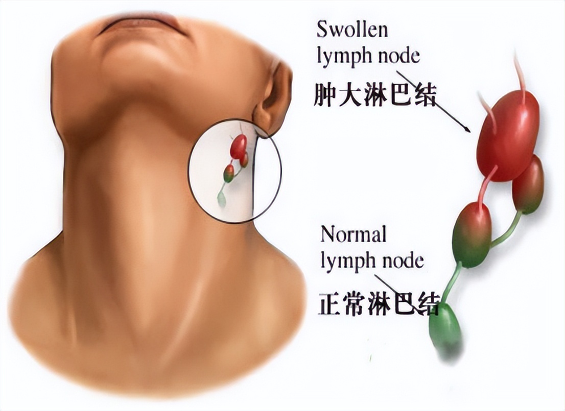 糖尿病患者体重减轻怎么回事,糖尿病患者体重明显增加