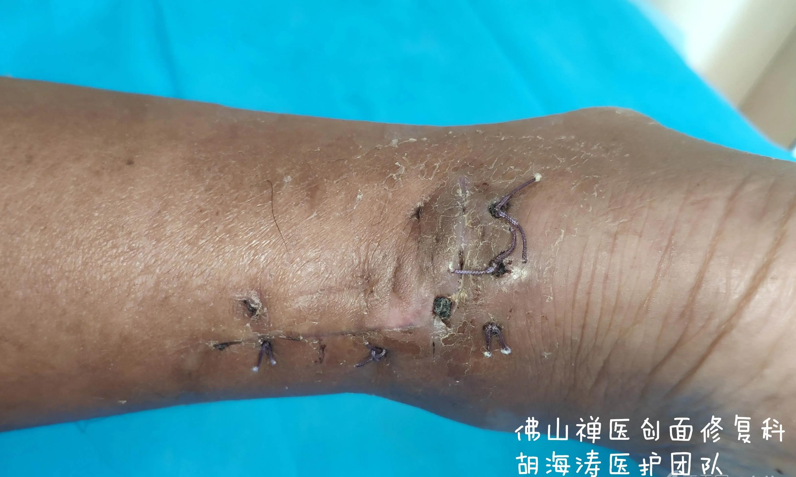 农民工受伤不去治疗,农民工受伤没去医院自己缝合伤口