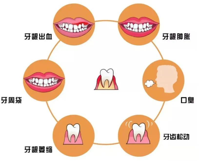 牙周炎犯了不治疗自己会自愈吗,得了牙周炎暂时不能去医院怎么办