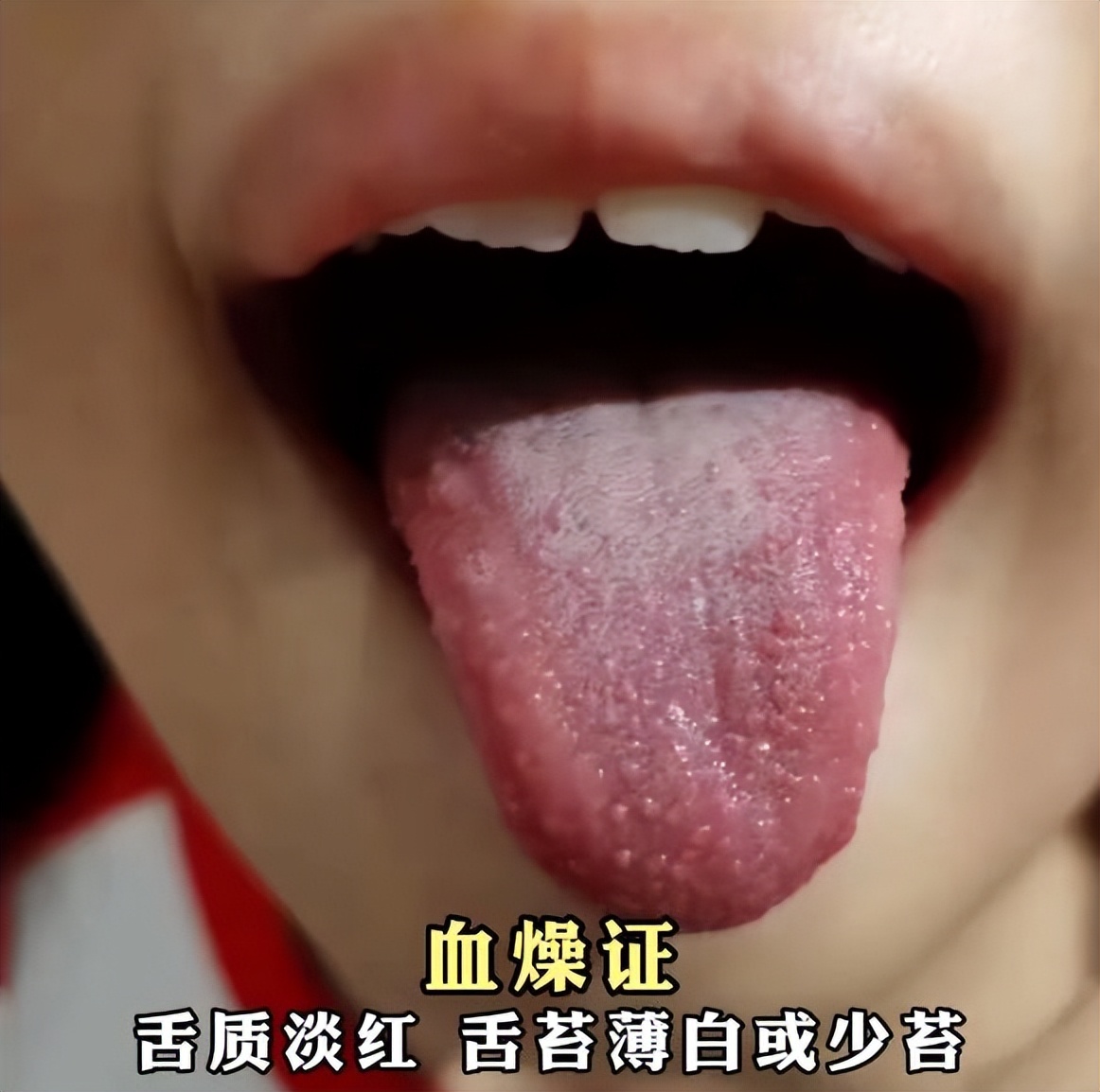 银屑病中医彩色图谱,银屑病舌象分型