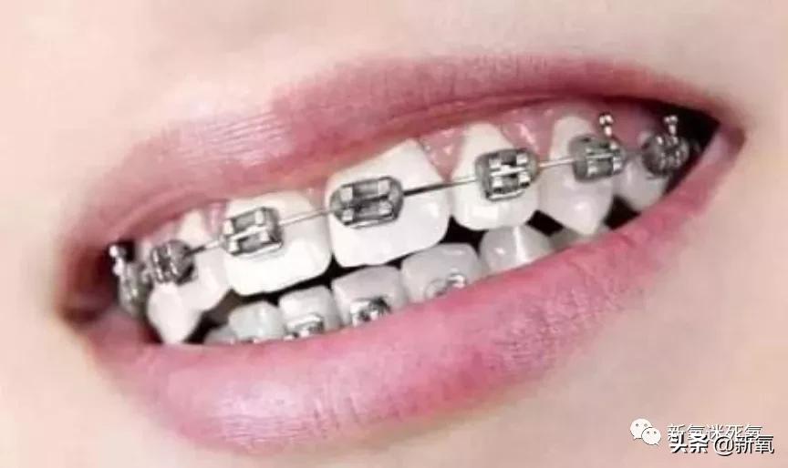为什么整牙脸会小,为什么整牙期间脸会变老