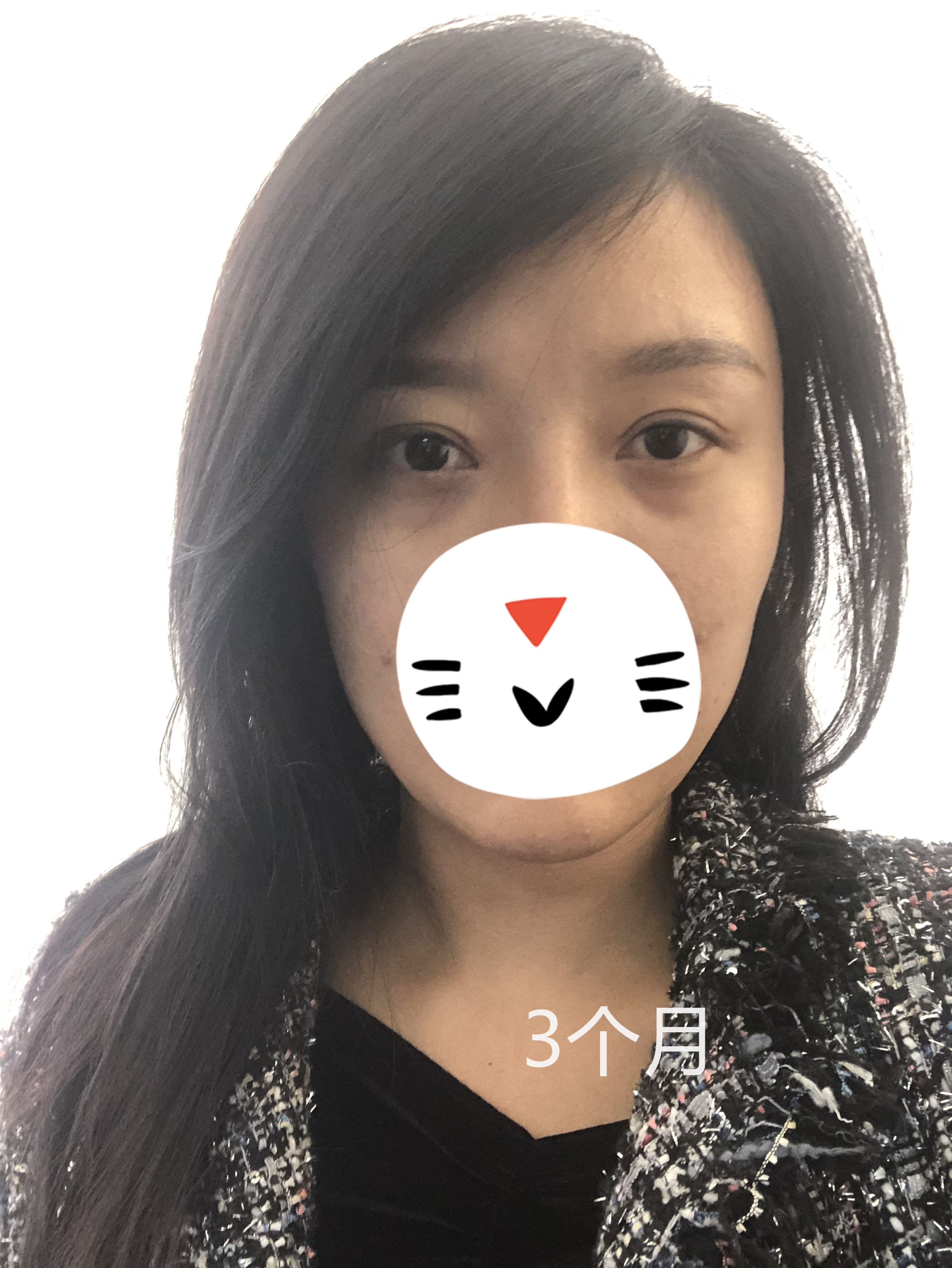 双眼皮修复新乡,姑娘眼部整形后双眼皮变三眼皮