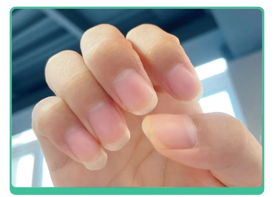 白斑、薄脆、凹陷，娃指甲有异常，不是缺营养，可能暗藏疾病