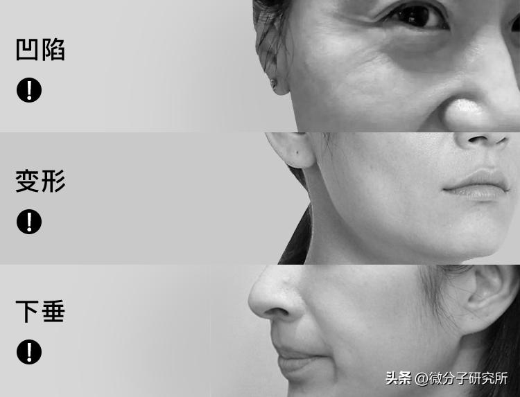 热玛吉后用的提拉面膜,热玛吉以后要医美面膜么