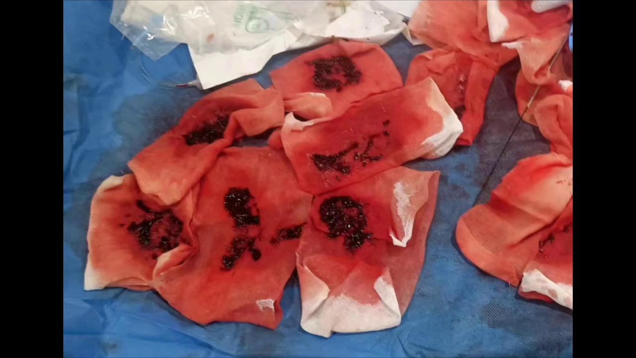 下肢深静脉血栓介入治疗视频,下肢腘静脉血栓保守治疗能治愈吗