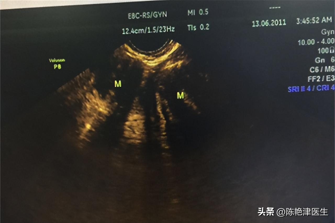 女性为什么容易长子宫肌瘤？提醒：平时尽量避免3个行为，别忽视