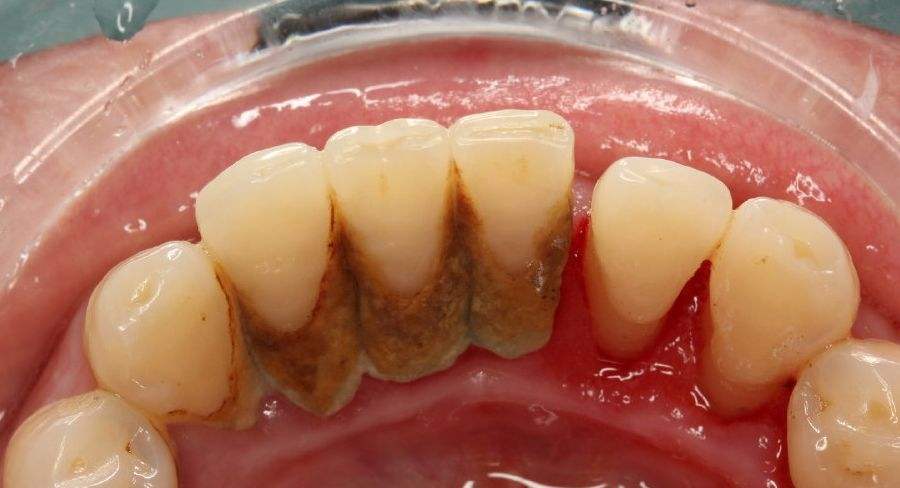 牙结石可以自己抠掉了,牙结石能自己抠掉吗