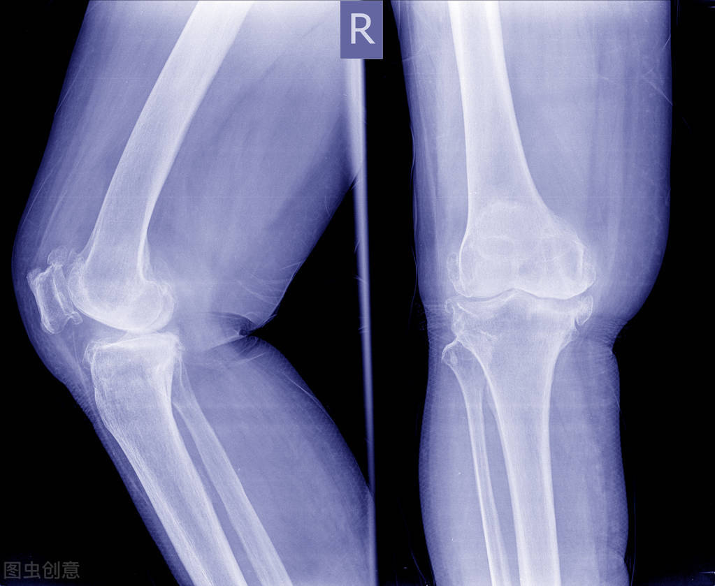 膝关节疼痛或外伤，做完手术在床上静养三个月就可以活动如初了？