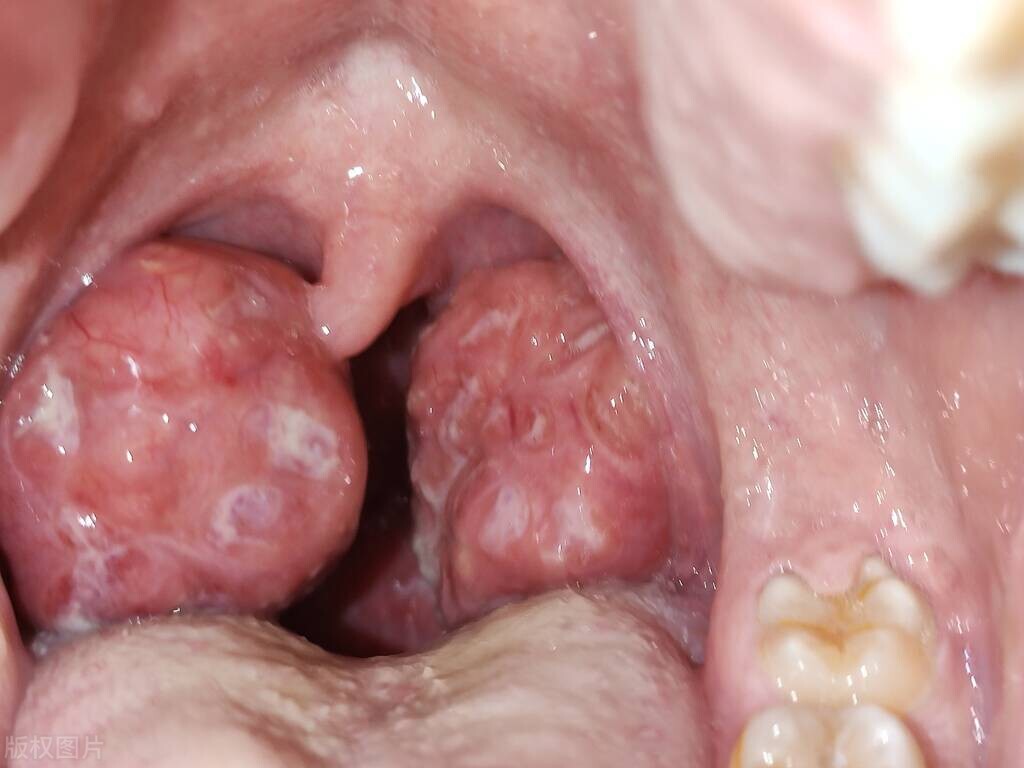 口渴老喝水可能是肾有问题吗,什么肾脏疾病越喝越口渴