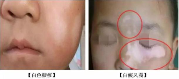 孩子脸上有白斑吃什么打虫药,小孩子脸上长白斑需要吃打虫药吗