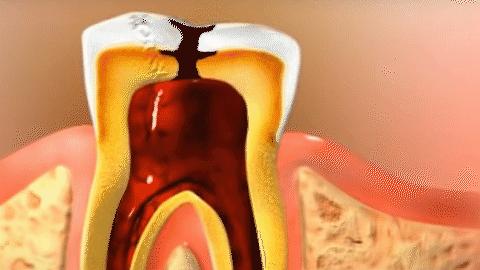 小孩做根管治疗断针,做根管治疗牙根会断吗