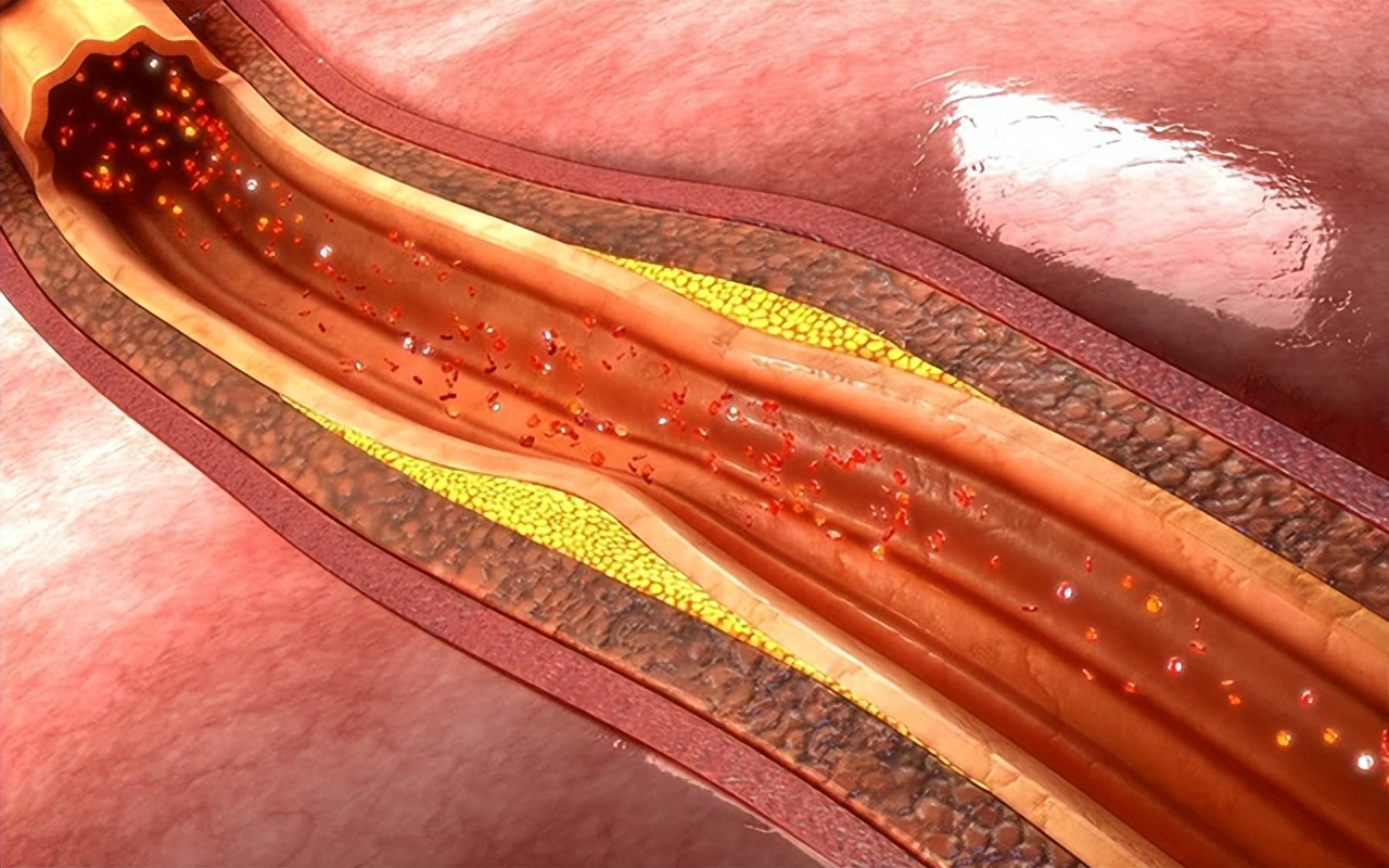 过敏性紫癜能治好吗复发率高吗,过敏性紫癜肾炎治愈后复发率多少