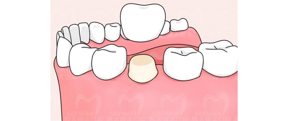 暨大穗华口腔种植一颗牙多少钱,暨大穗华口腔1980种牙靠谱吗