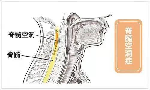 磁共振脊髓空洞影像学表现,脊髓空洞核磁表现增强