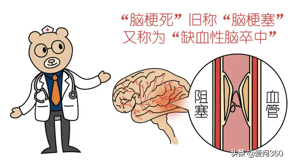 脑梗来前有什么症状,脑梗前的6个表现您一定要重视