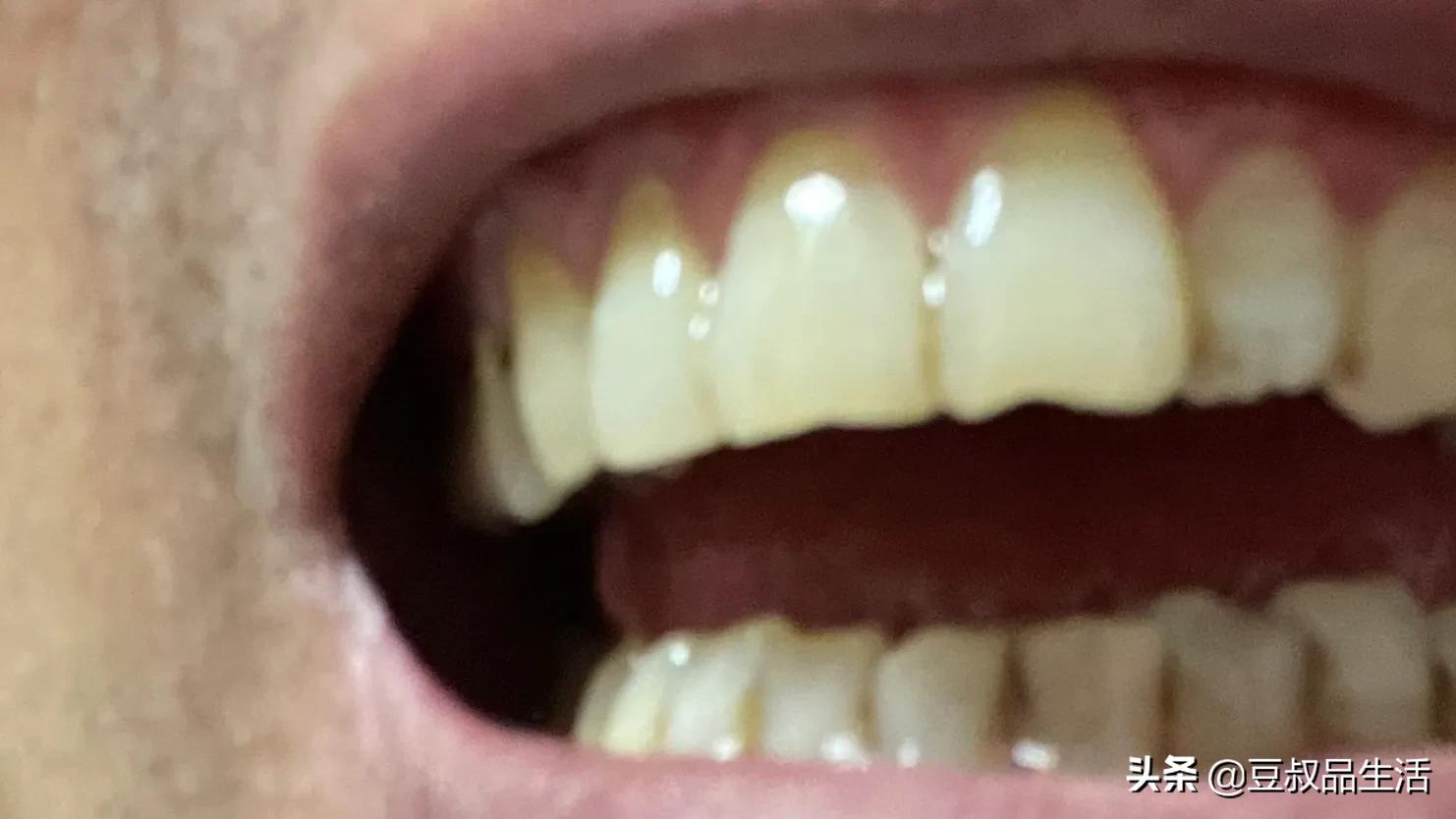 看牙疼看出了头疼事，是怎么回事呢？也许跟你也有关