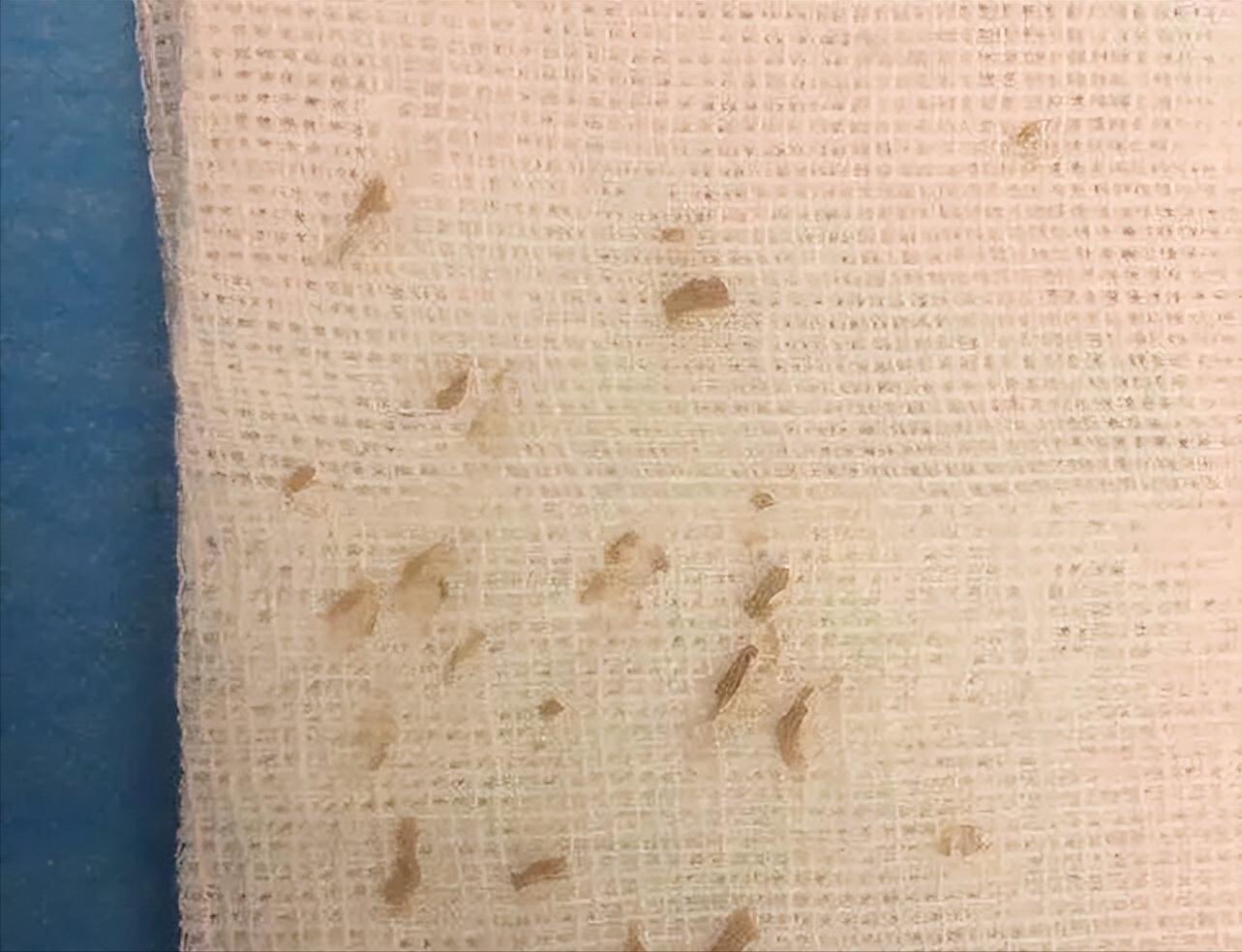 鼻子的黑头跟草莓一样,草莓黑头怎么去除最有效