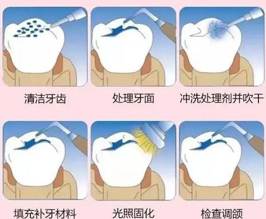 树脂嵌体补牙一般收费多少,做了树脂补牙以后还能做嵌体吗