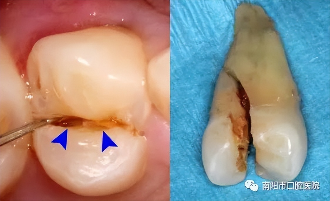 医生问你牙怎么这么不好,医生说我的牙齿裂开了怎么治疗