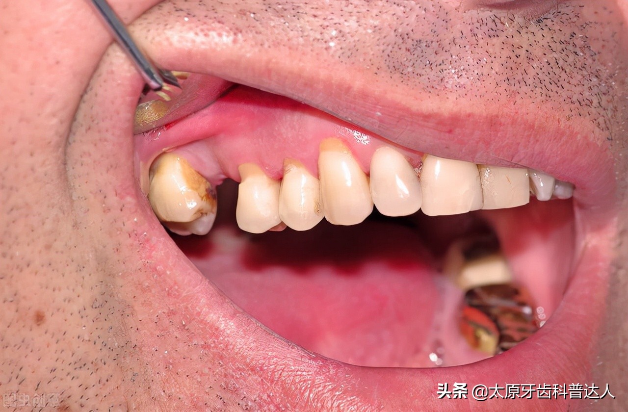 牙齿楔状缺损补牙过程,因牙齿缺损造成的牙疼