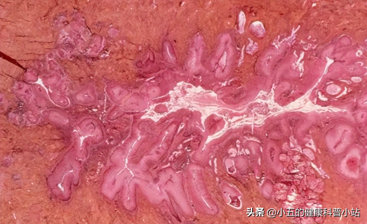 宫颈癌早期症状不典型，若出现3个症状尽早检查，或是宫颈癌信号