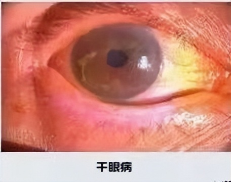 眼干眼涩眼模糊不清吃啥药,眼干眼涩看不清怎么治