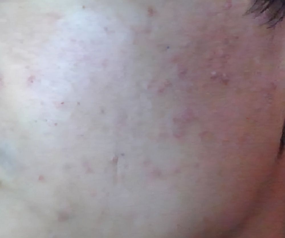 油脂性闭口是闭口粉刺吗,长闭口粉刺什么原因导致的