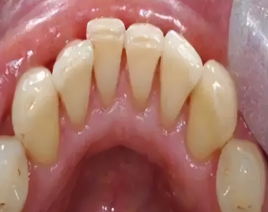 去除牙黄牙结石专用牙膏测评,专治牙黄口臭的牙膏测评