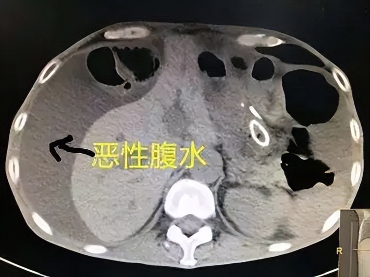 肿瘤腹水怎么消除最快最有效,癌症出现腹水中药调理