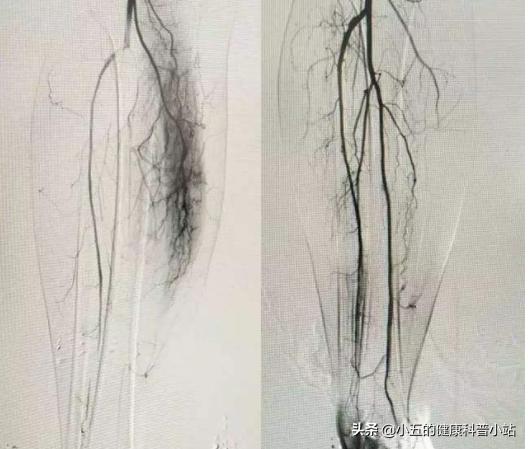 人老腿先衰8个表现预示你已衰老,人老腿先老的三种表现