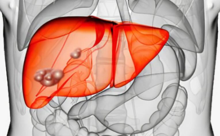 什么是肝实质性占位,什么情况肝占位需要做手术