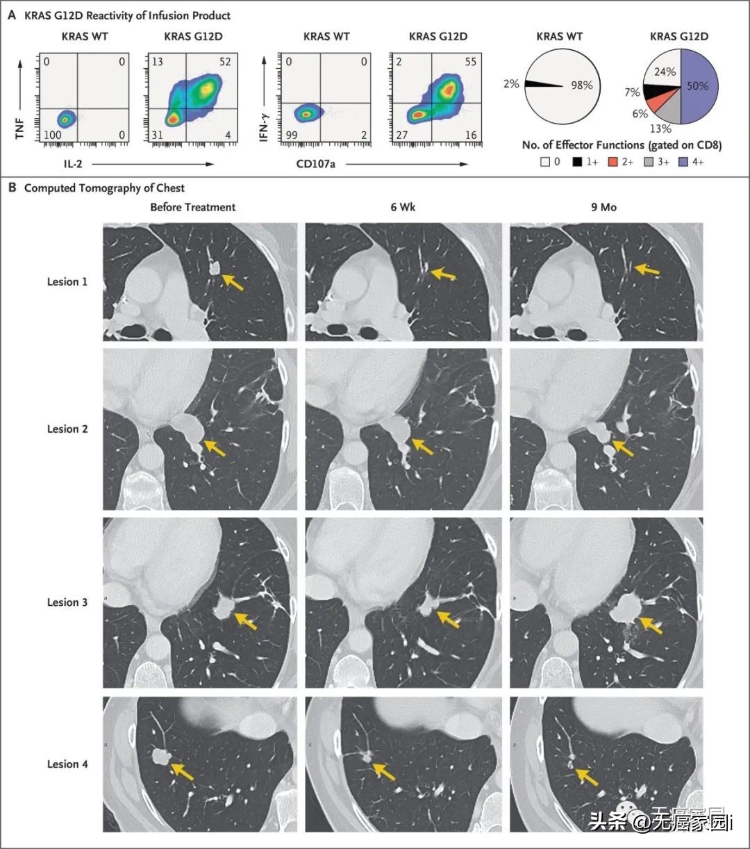 til细胞疗法能治愈癌症吗,til细胞疗法临床治愈肺癌
