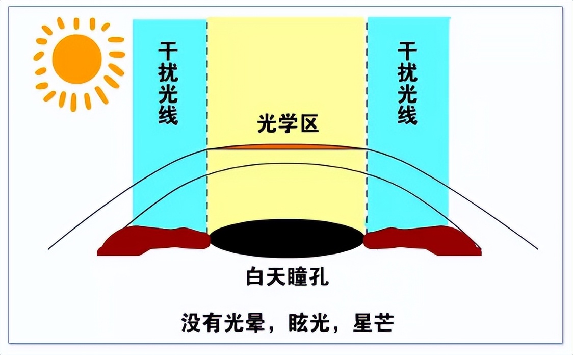 「专家解答」佩戴ok镜后孩子为什么感觉叠影和眩光？