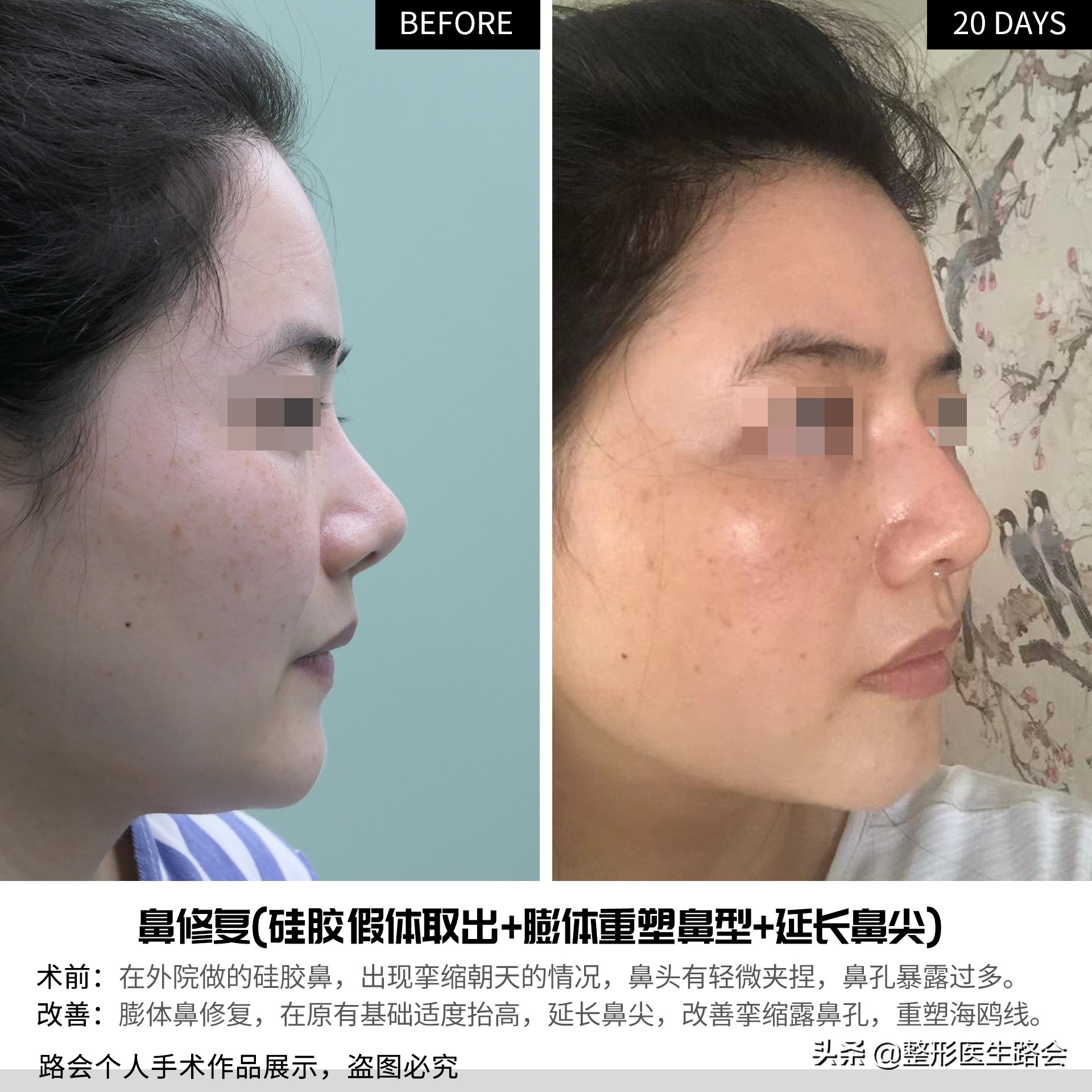 硅胶隆鼻5年歪了怎么修复,隆鼻10天歪了可以矫正吗