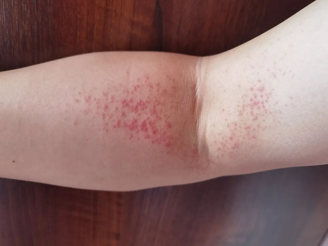 胳膊连着腋下有红色疹子,胳膊肘突然起了好多小红点