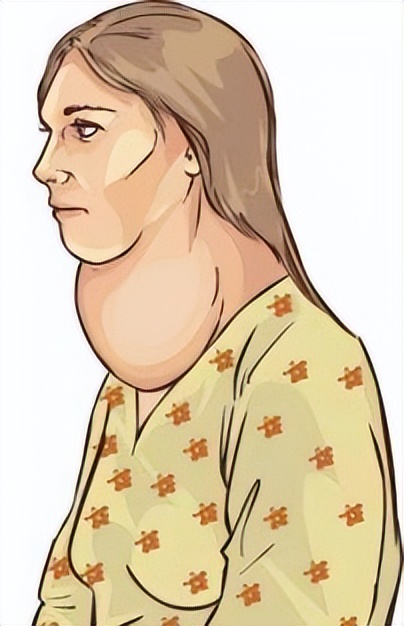 10个人里3个中招！体检发现甲状腺结节咋办？