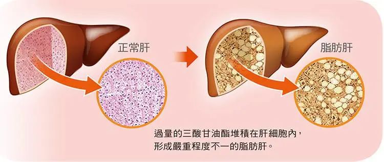 孕期脂肪肝是什么症状,孕期脂肪肝怎么引起的