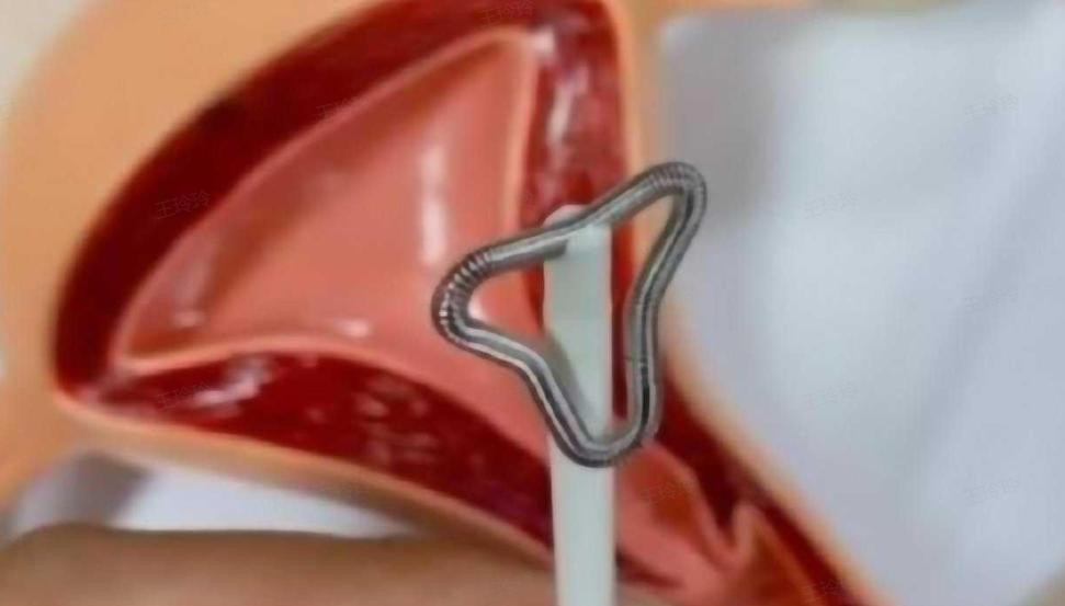 中国第一批“上环”的女性，医生直言：30年了，难逃出这4种结局