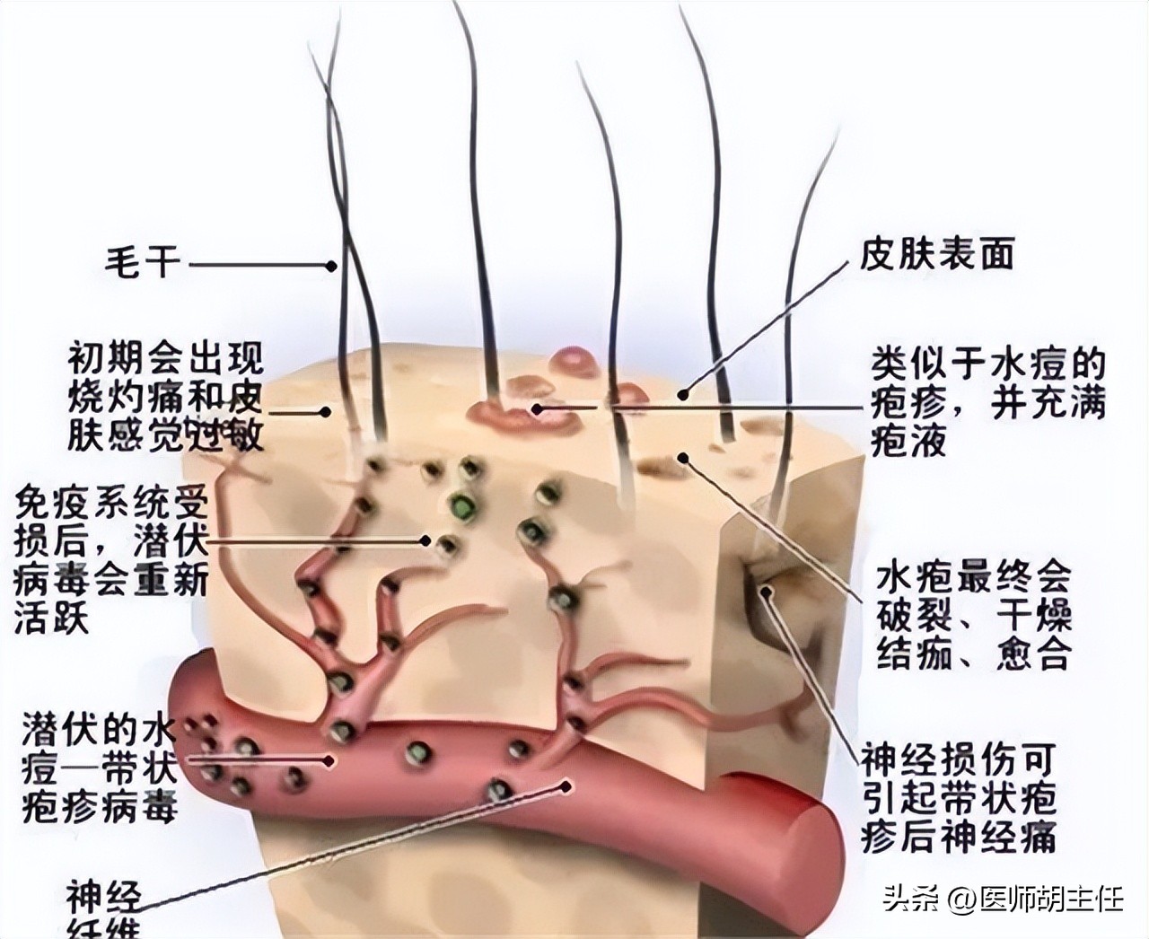 缠腰蛇疱疹干了为什么还很疼,缠腰蛇疱疹什么样