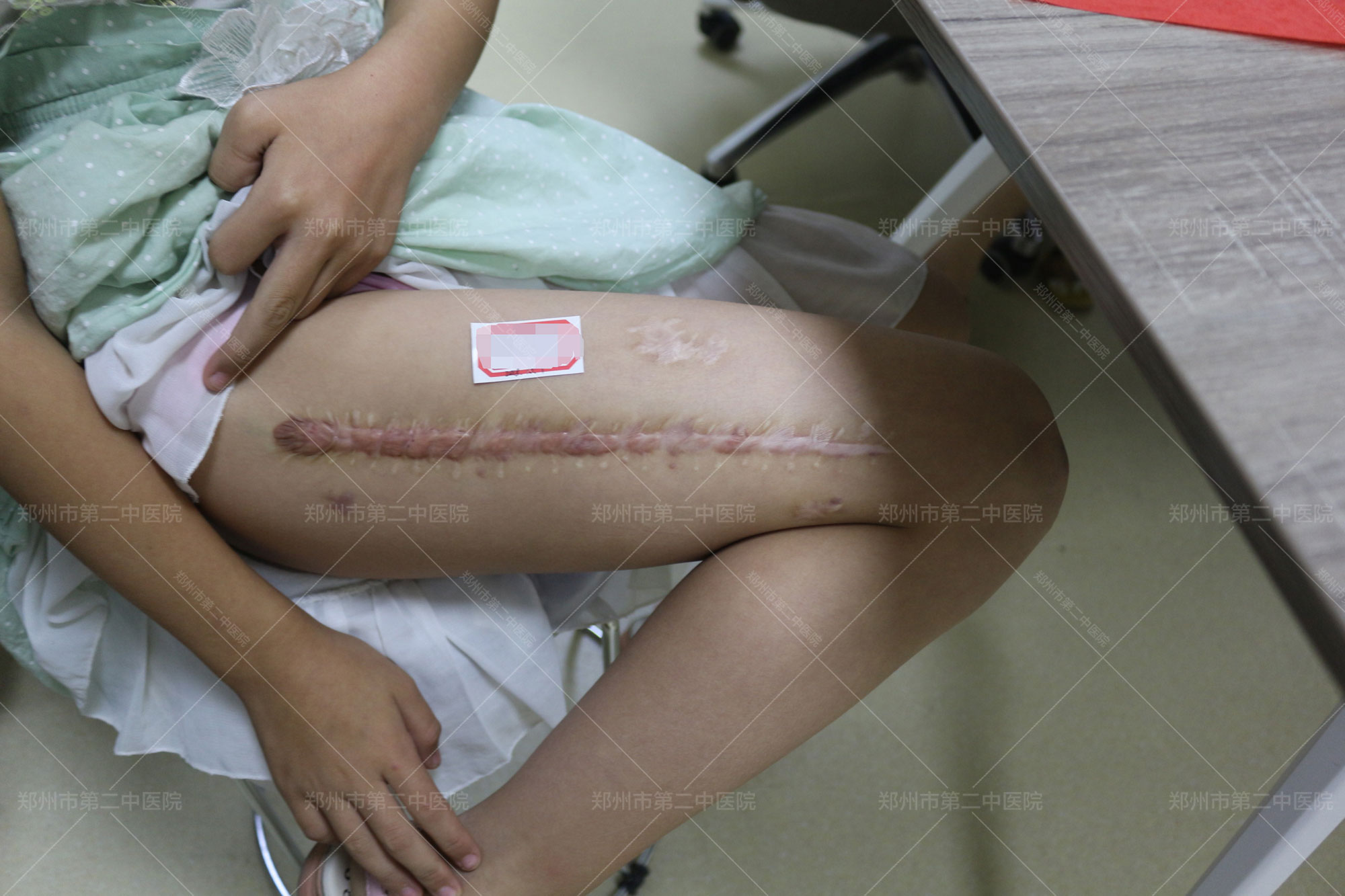 郑州哪个医院擅长治疤痕,郑州第二中医院怎么祛疤痕