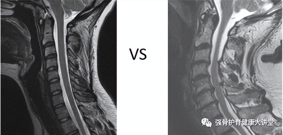 颈椎核磁和核磁共振哪个比较安全,怎样看懂颈椎核磁共振