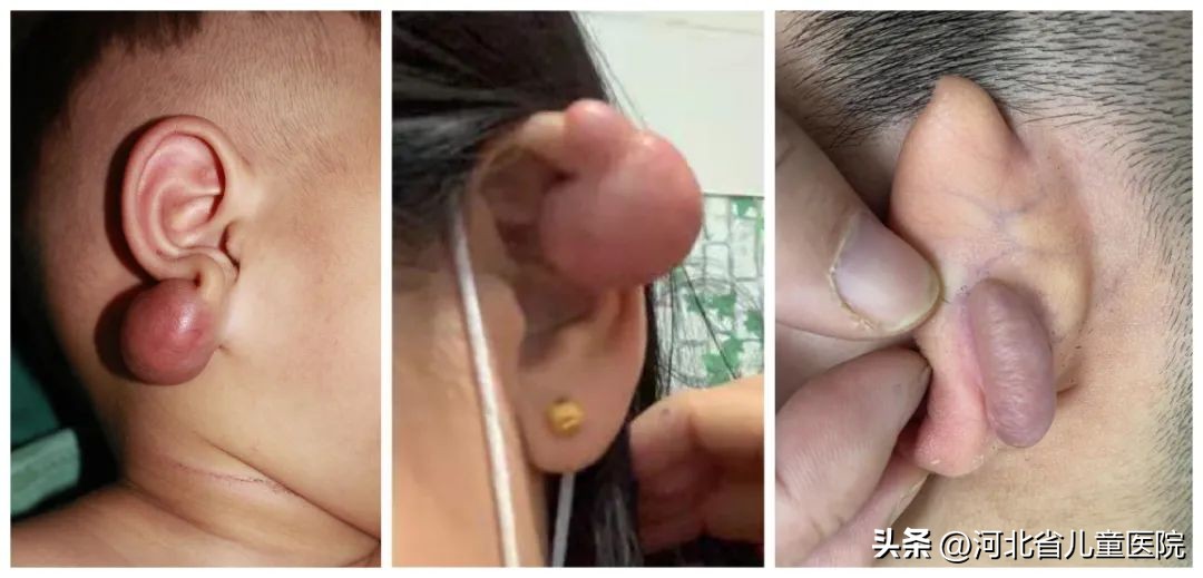 耳朵上的大面积疤痕怎么去除,耳朵疤痕疙瘩去除的方法