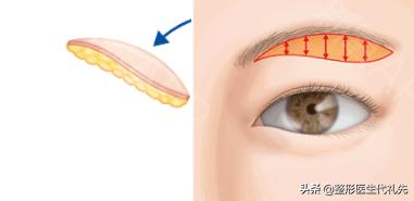 提眉外切眼袋7天后能化妆吗,提眉手术后多久可以做全切眼袋
