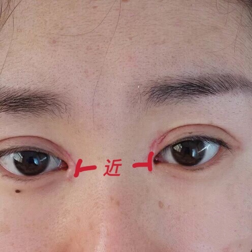 整形科普知识修复双眼皮,双眼皮整形有哪些常见方法