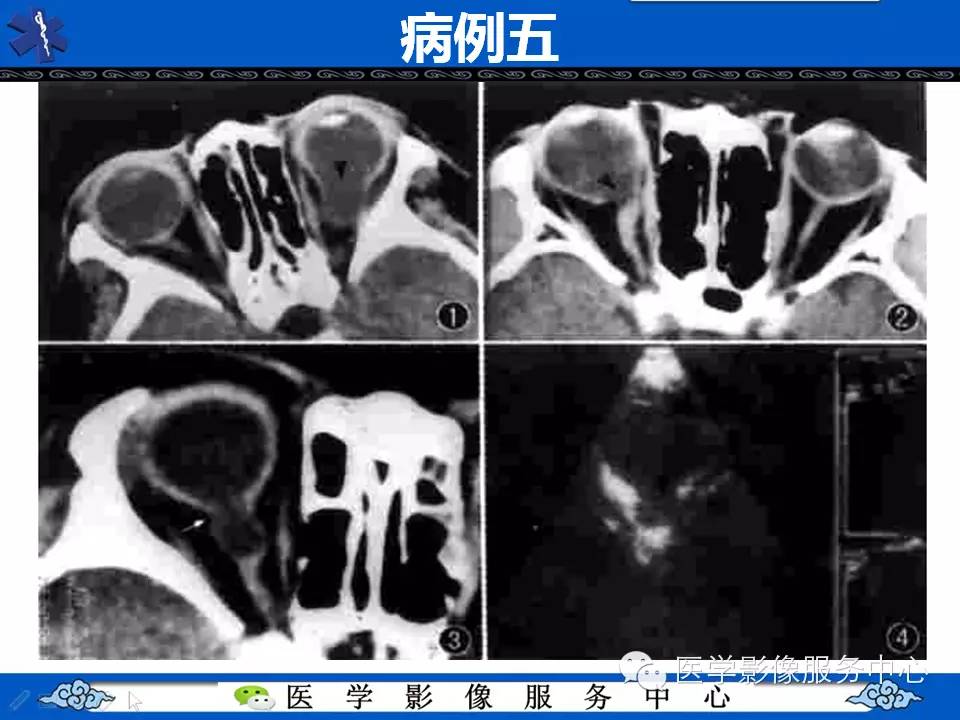 牵牛花综合征可能误诊吗,牵牛花综合征视角